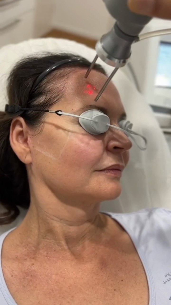 Dr. med. Natalie Wiesen lässt sich selbst mit dem CO2-Laser behandeln – Startbild des Videos